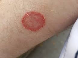 Ringworm